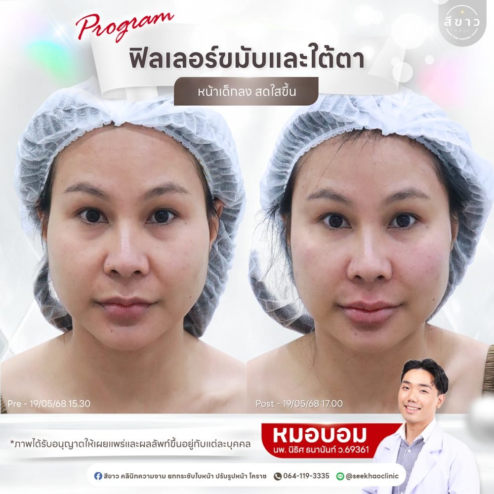 เคสจริง ฟิลเลอร์ขมับและใต้ตา