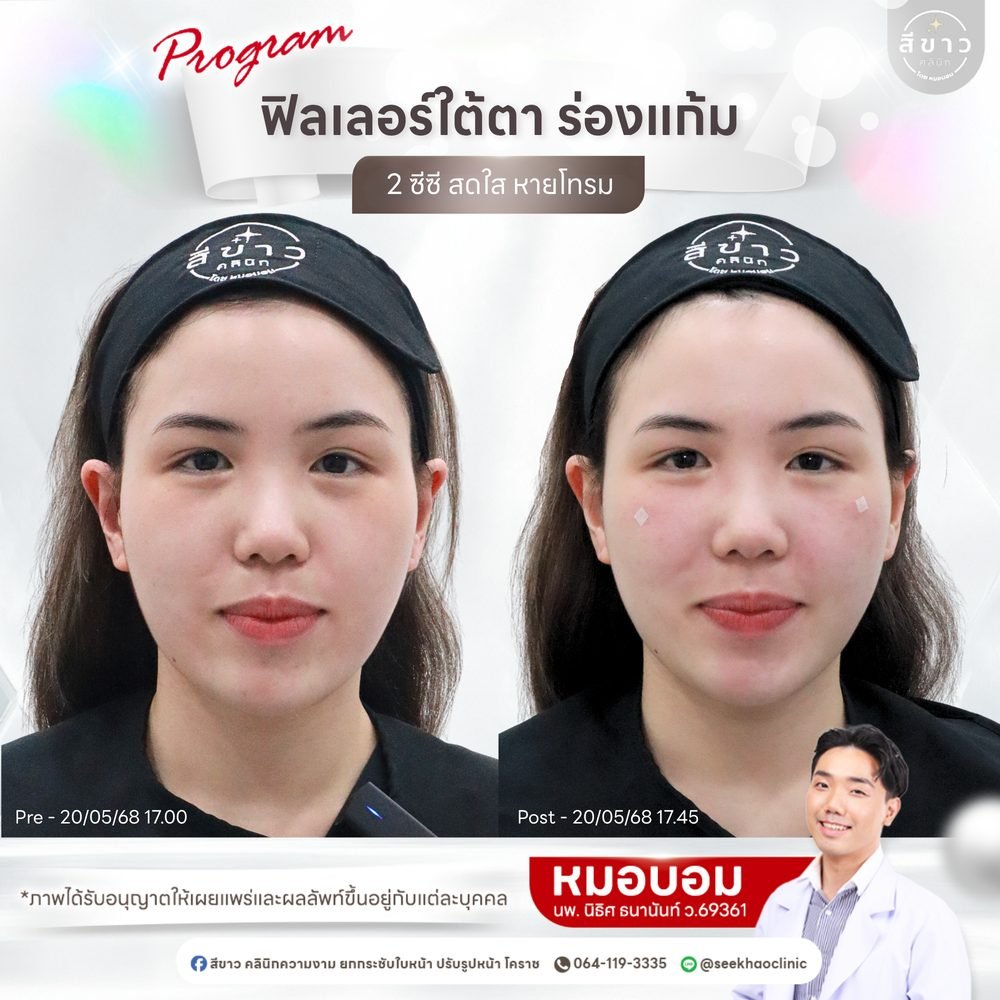 เคสจริง ฟิลเลอร์ใต้ตา ร่องแก้ม 2 cc