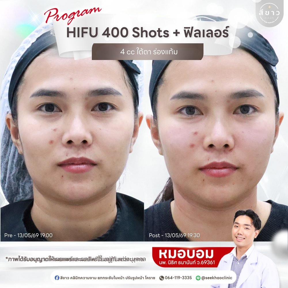 เคสจริง HIFU 400 shots + ฟิลเลอร์ 4 cc