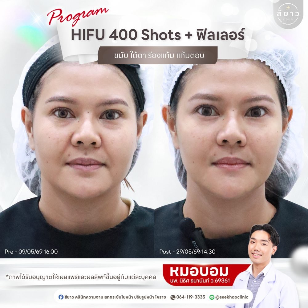เคสจริง HIFU 400 shots + ฟิลเลอร์