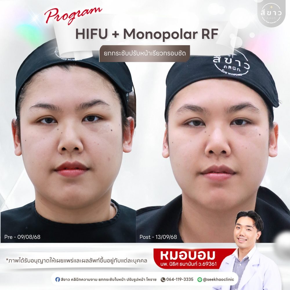 เคสจริง HIFU + Monopolar RF