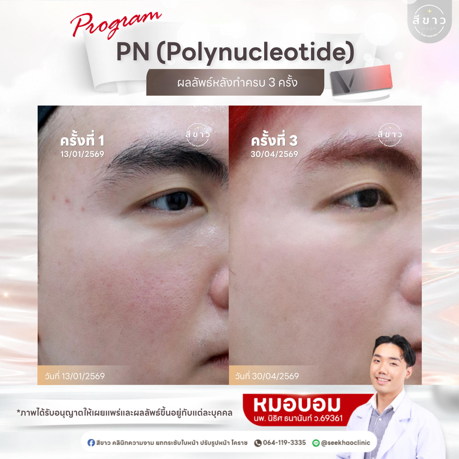 เคสจริง PN ครบ 3 ครั้ง — ผิวเรียบเนียนขึ้น