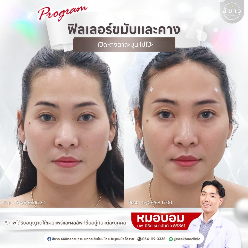 เคสจริง ฟิลเลอร์ขมับและคาง