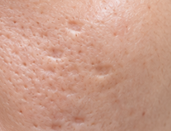 หลุมสิวแบบ Boxcar Scar