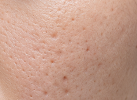 หลุมสิวแบบ Ice Pick Scar